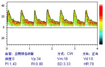 经颅多普勒报告中间频谱图含义.jpg