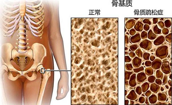 骨质健康问题.jpg