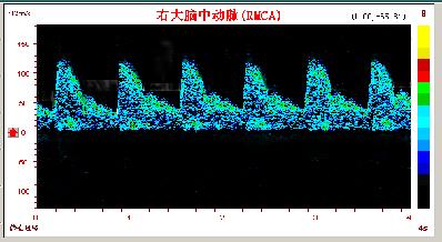 超声经颅多普勒脑动脉硬化频谱图.jpg