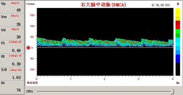 超声经颅多普勒脑动脉瘤频谱图.jpg