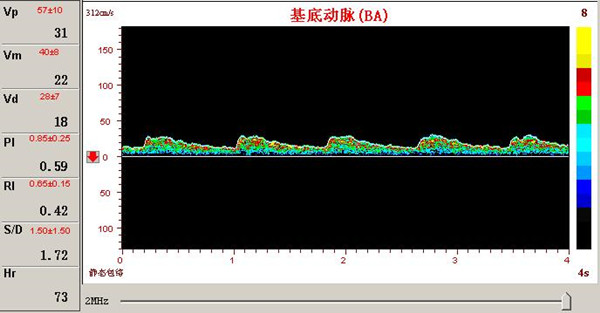 超声经颅多普勒基底动脉供血不足频谱图.jpg