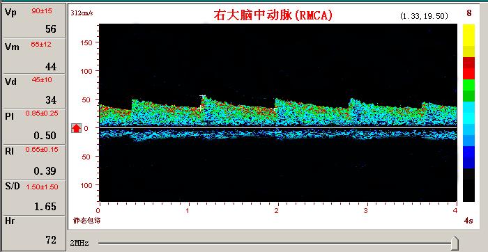 超声经颅多普勒脑血管扩张频谱图.jpg