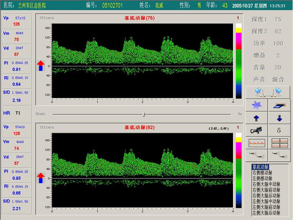 超声经颅多普勒血流分析仪双窗口（双通道或双深度）检测界面.jpg