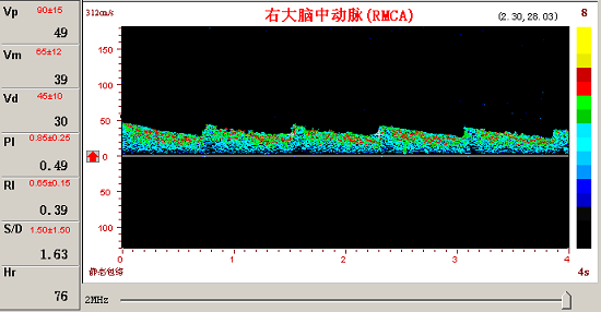 KJ系列超声经颅多普勒脑动脉瘤频谱图