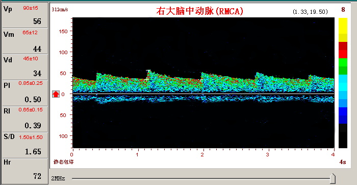 超声经颅多普勒的脑血管扩张频谱图